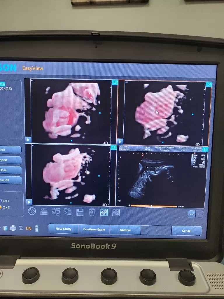 Portable 3D ultrasound machines typically have many of the same features as larger, stationary machines, including volumetric imaging, multiplanar imaging, spatial compounding, and real-time imaging.